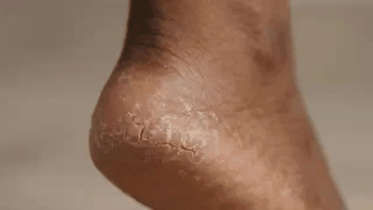 PEDILIS™ — Lime Électrique Anti-Callosités pour des Pieds Plus Lisses